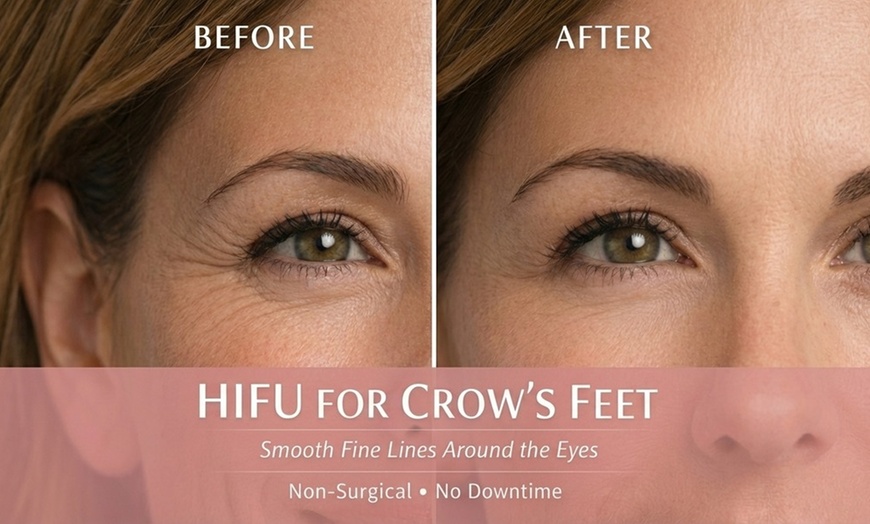 Image 3: HIFU Brow Lift & Fine Line Smoothing (No Needles)
