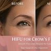 Image 3: HIFU Brow Lift & Fine Line Smoothing (No Needles)