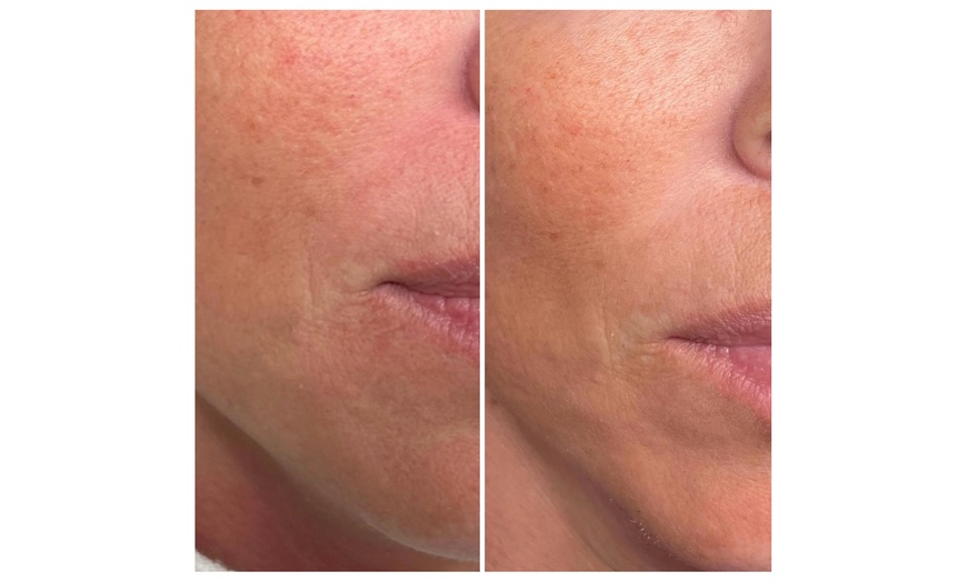 Image 6: Transform Your Skin with One or Two PRP Micro-Needling