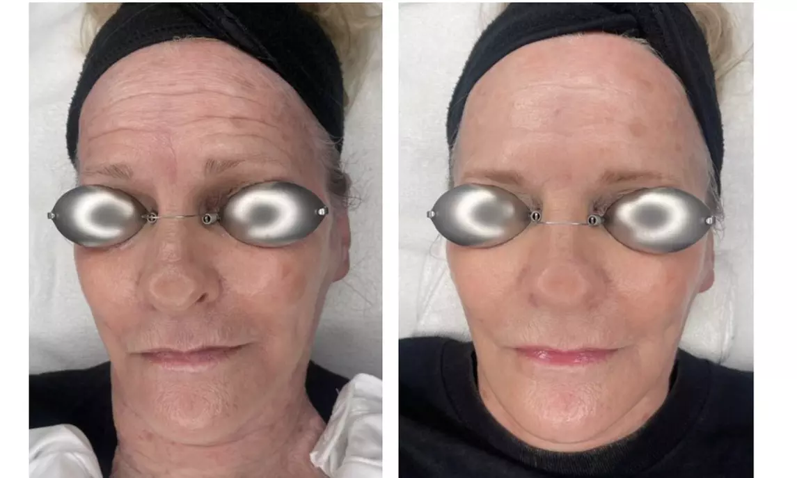 20 or 40 Units of Botox