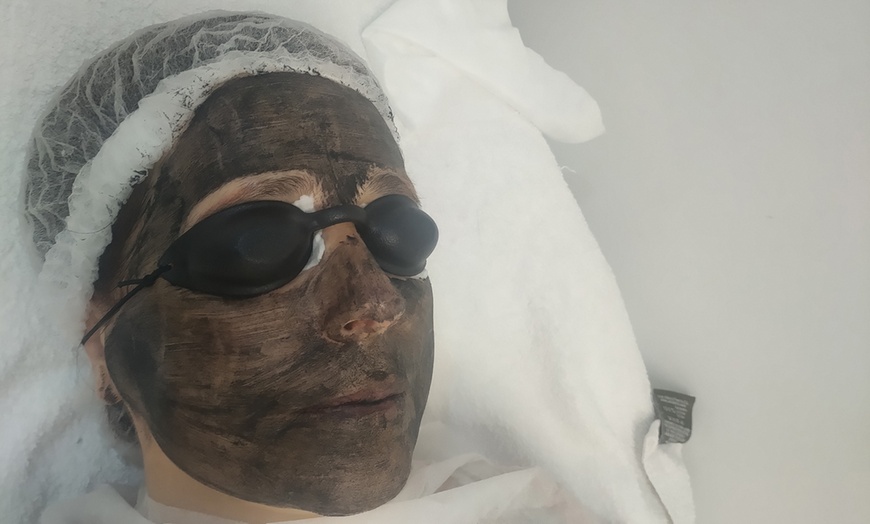 Image 1: Peeling Hollywood con carbón activo, láser y vitaminas para el rostro