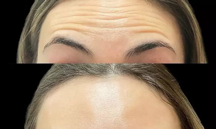 Smooth Away Lines with Botox Lip Flip, 20 or 40 Units of Botox