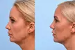 Rebuild Collagen with 2cc, 3cc, 4cc, or 5cc of Sculptra Injections at SlimmThicc Aesthetics Spa (Up to 31% Off) - Second Medium
