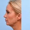 Image 5: Boost Collagen with 2 CC, 3 CC, 4 CC, or 5 CC of Sculptra Injections