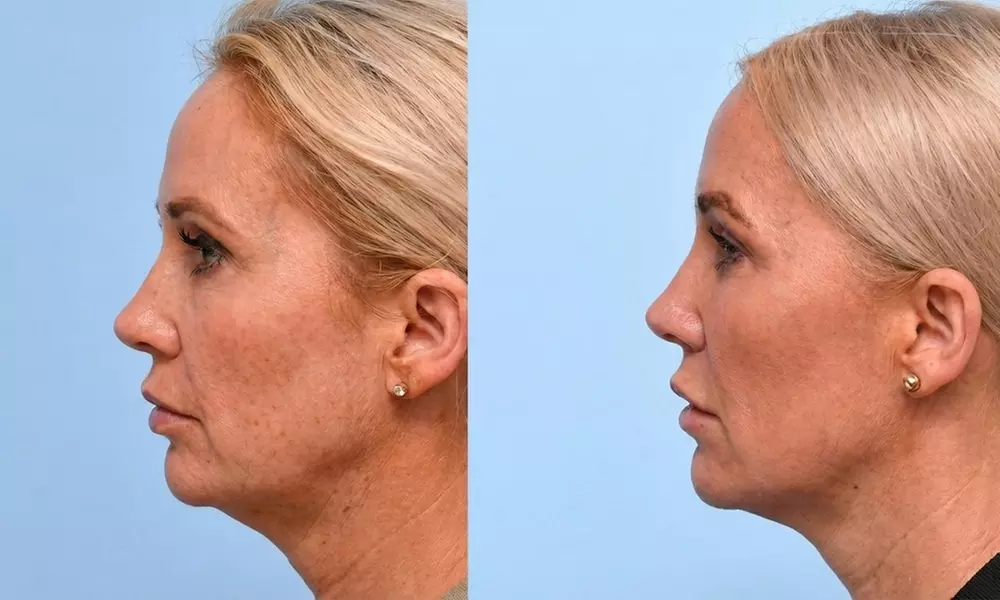Boost Collagen with 2 CC, 3 CC, 4 CC, or 5 CC of Sculptra Injections