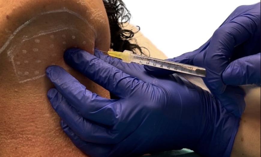 Image 6: ✨ Say Goodbye to the Double Chin with Kybella® ✨