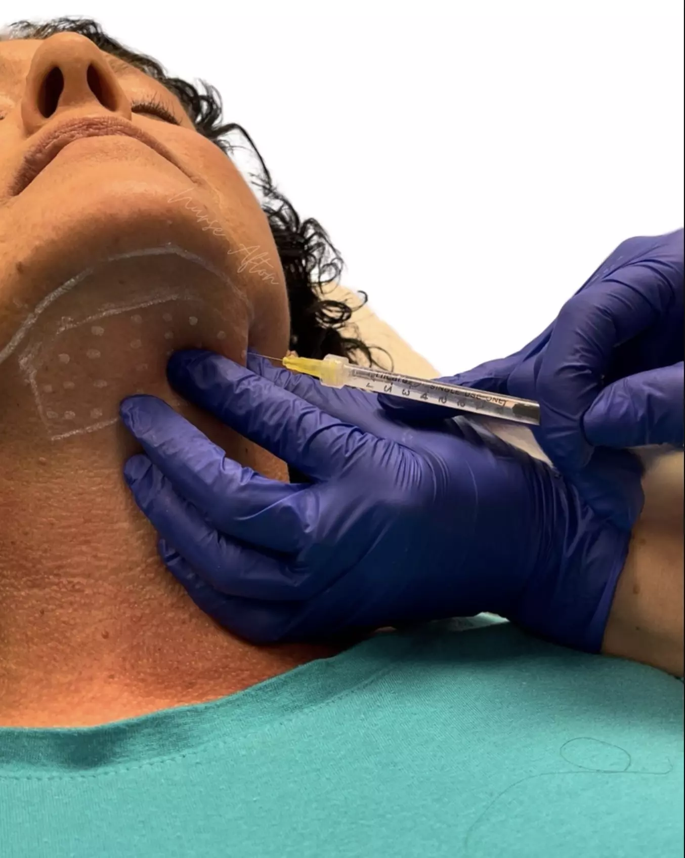 ✨ Say Goodbye to the Double Chin with Kybella® ✨