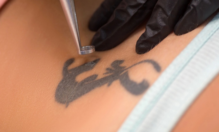 Image 3: One or Three Laser Tattoo Removal for Small, Medium or Large Areas