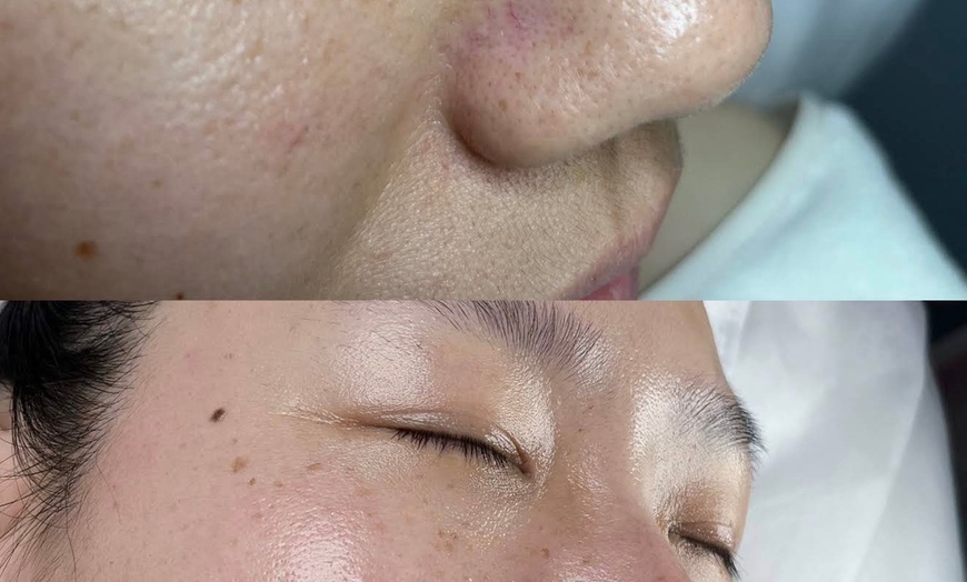 Image 4: Up to 75% Off on Deep Pore cleasing Microdermabrasion