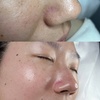 Image 4: Up to 75% Off on Deep Pore cleasing Microdermabrasion