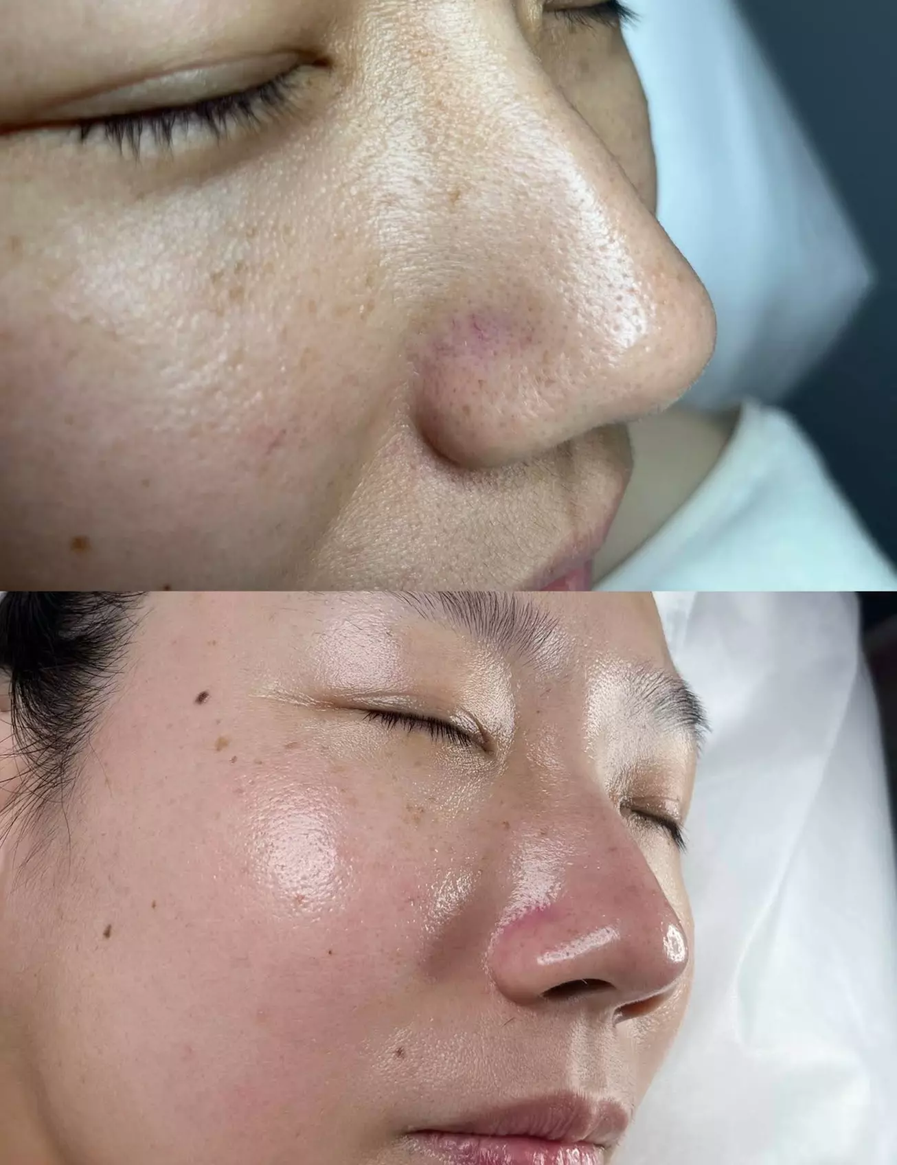 Up to 77% Off on Deep Pore cleasing Microdermabrasion