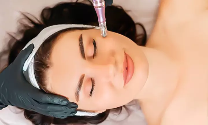 Transform Your Skin with One or Three Microneedling + PRP Sessions at Lily Aesthetics (Up to 49% Off) - Primary Image
