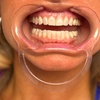 Image 2: Revitalize Your Smile with Professional Teeth Whitening Options