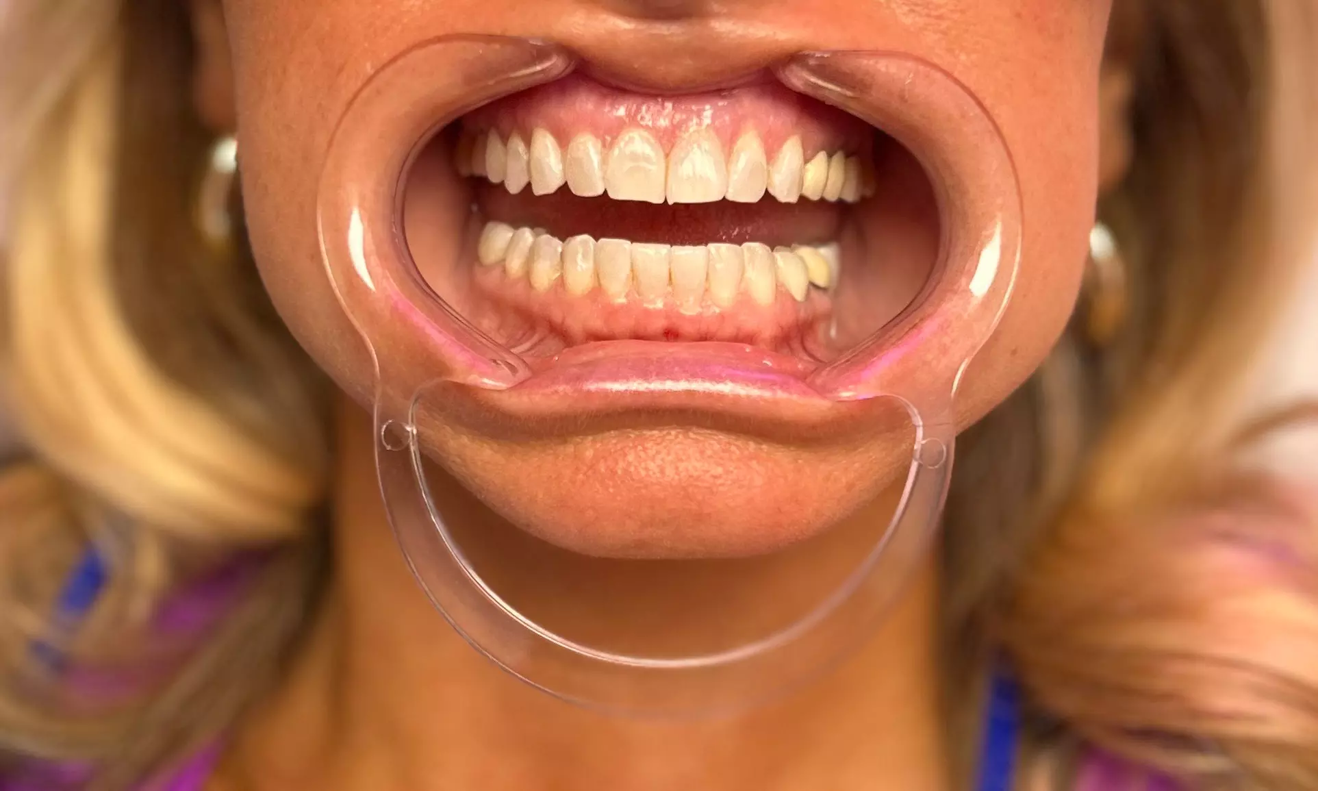 Revitalize Your Smile with Professional Teeth Whitening Options