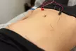Experience the Benefits of Acupuncture w/ 1, 3 or 5 Sessions at Yoo Balance therapy and wellness (Up to 55% Off) - Second Medium