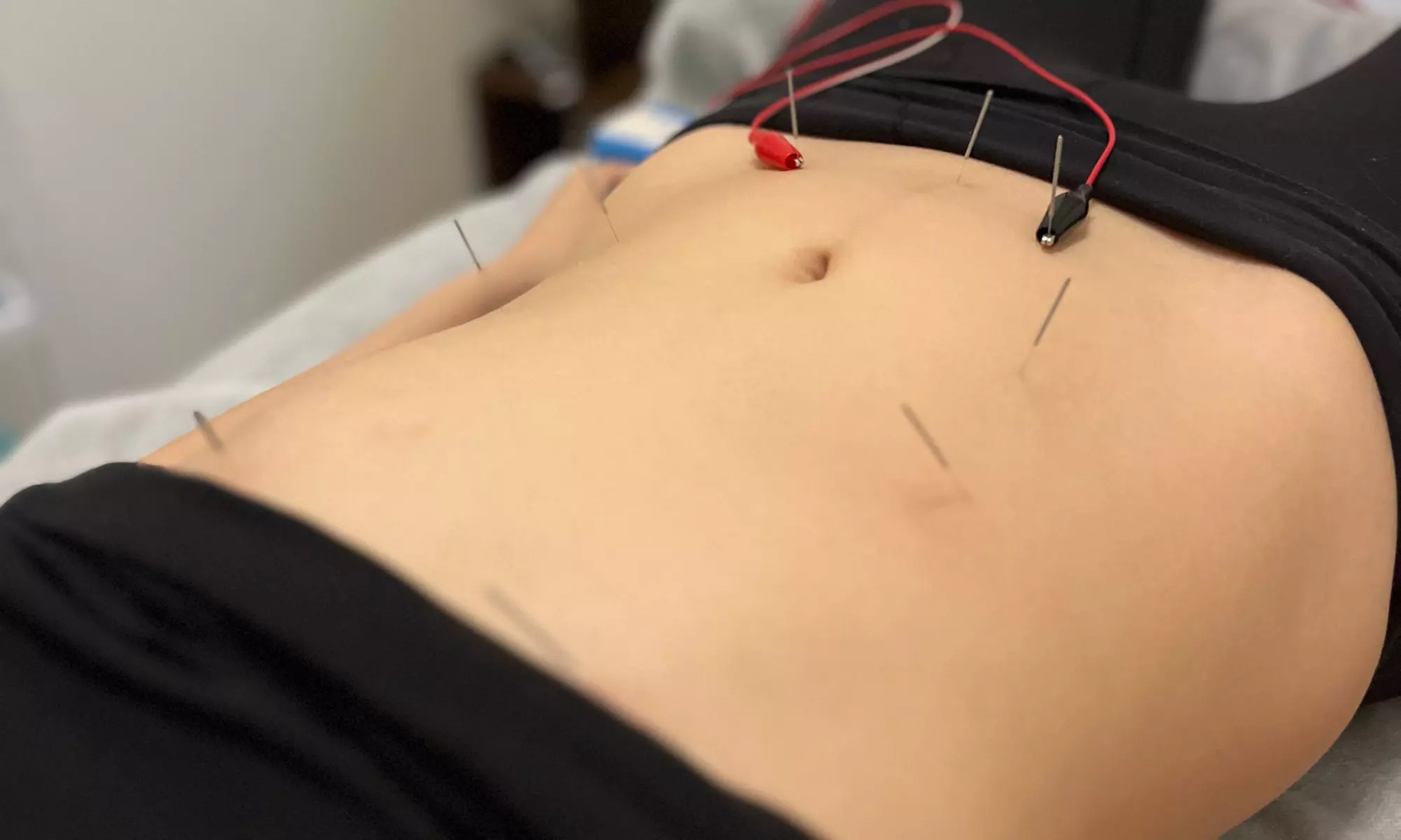 Experience the Benefits of Acupuncture with 1, 3, or 5 Sessions
