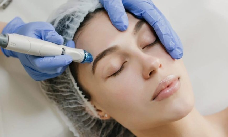 Image 4: 1, 2 o 3 sesiones de radiofrecuencia facial Indiba rostro completo