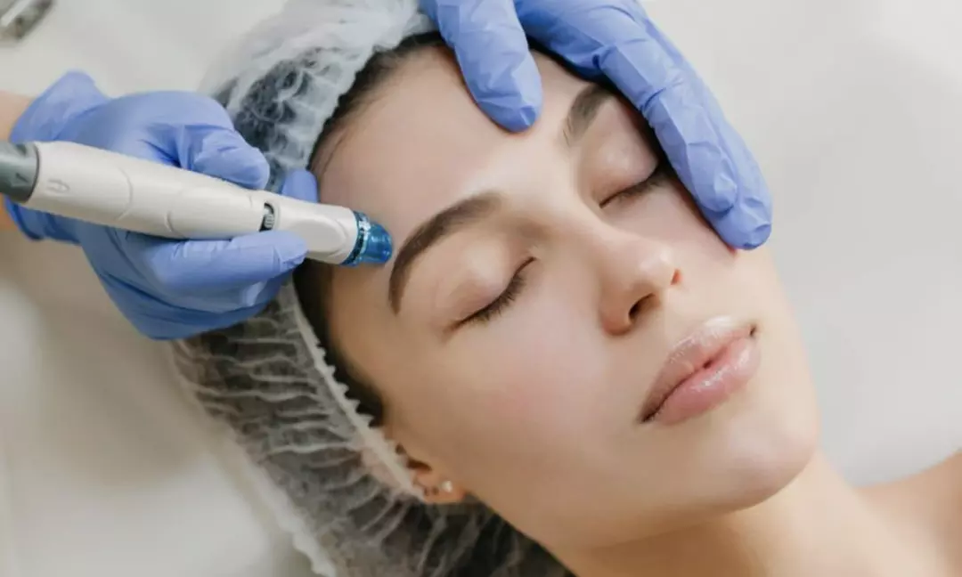 1, 2 o 3 sesiones de radiofrecuencia facial Indiba rostro completo