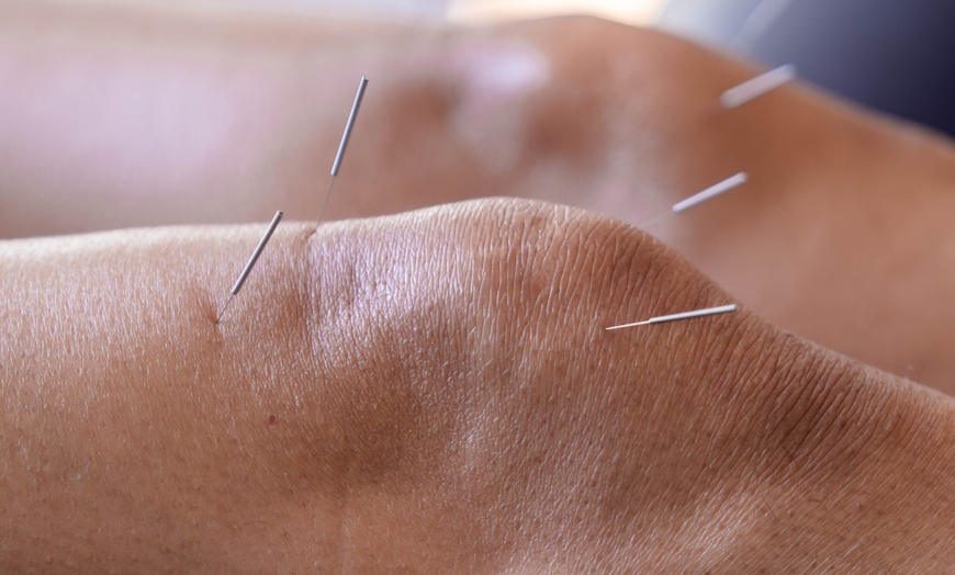 Image 9: Cupping with Deep Tissue Massage or Acupuncture in Shoreditch, London