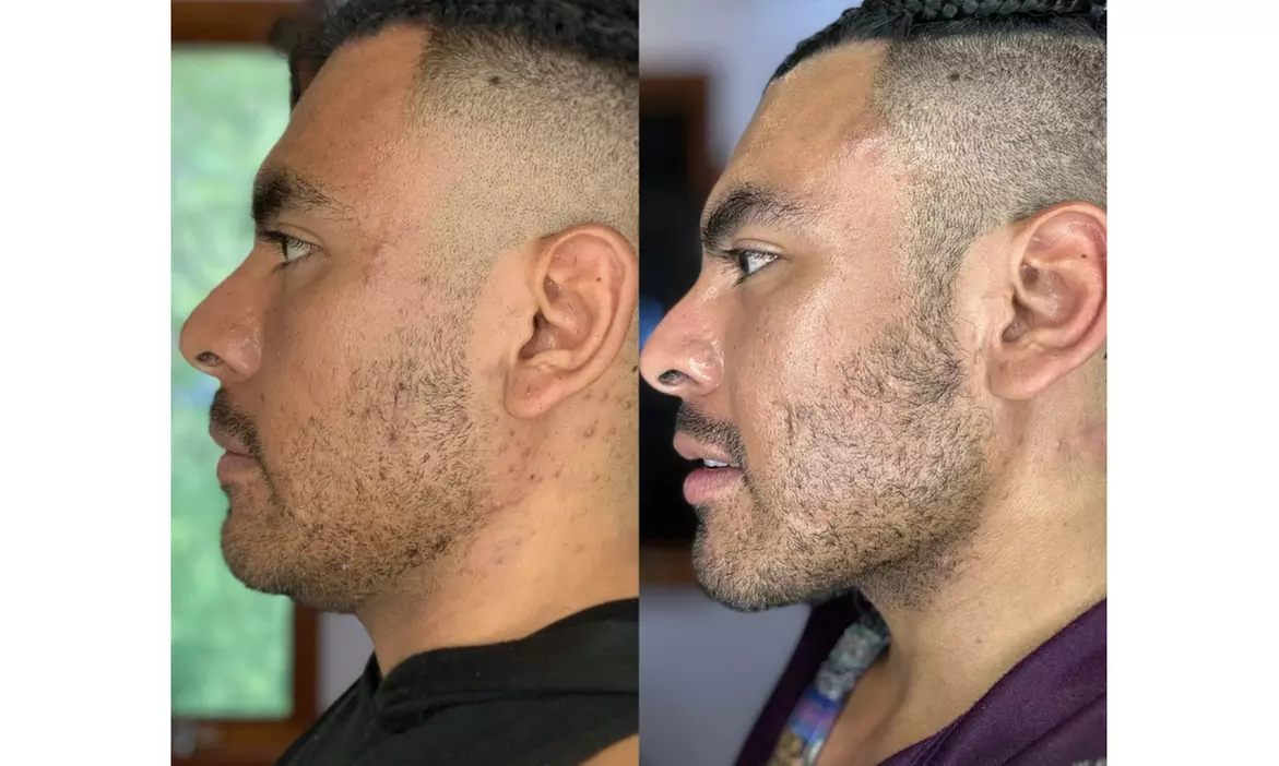 Tone with Five Sessions of Body Sculpting - Small or Large Area