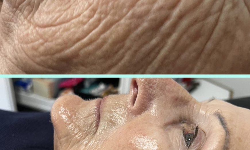Image 4: One HIFU Non Surgical Facelift Treatment for One Face Zone, Full Face