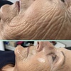 Image 4: One HIFU Non Surgical Facelift Treatment for One Face Zone, Full Face