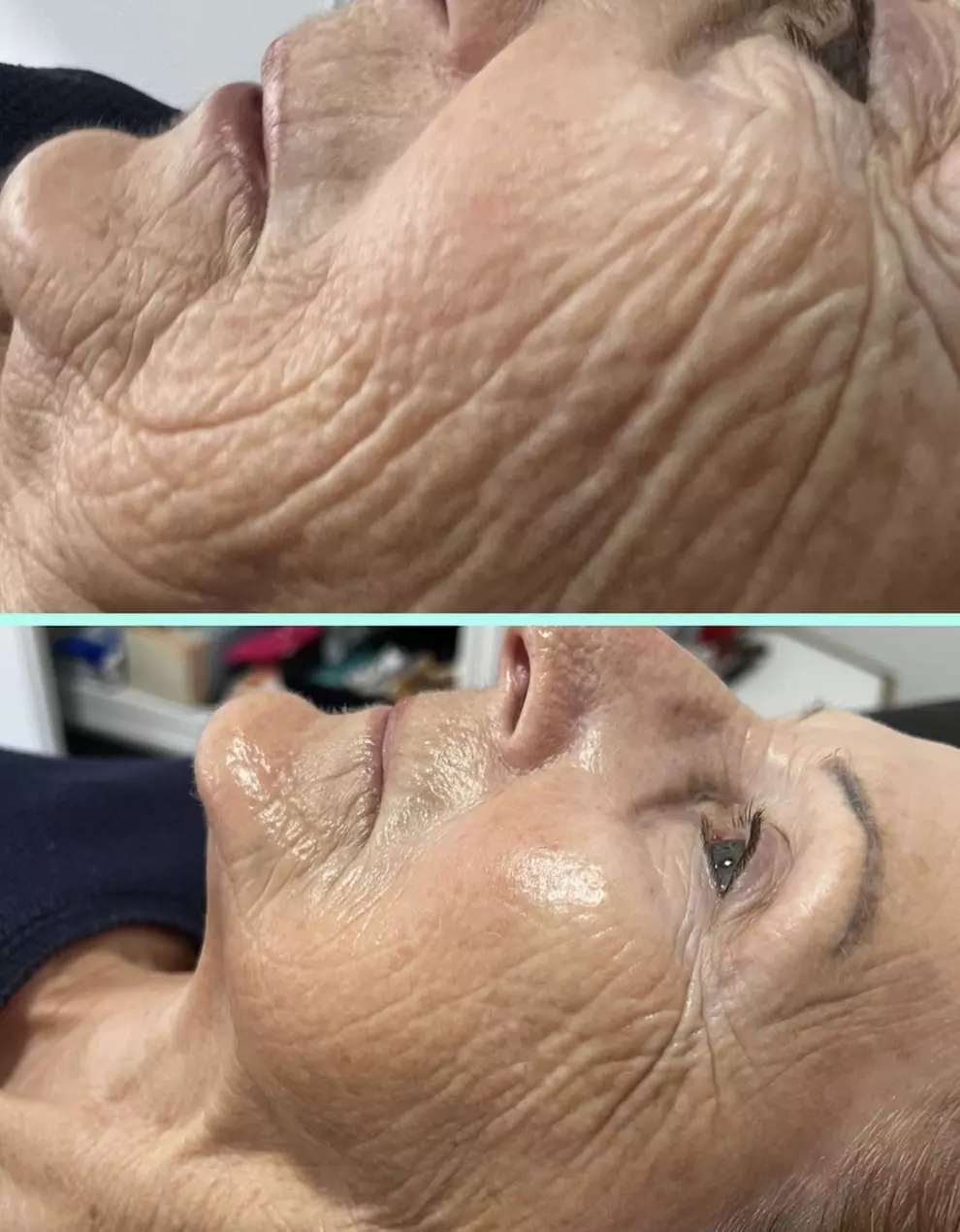 One HIFU Non Surgical Facelift Treatment for One Face Zone, Full Face