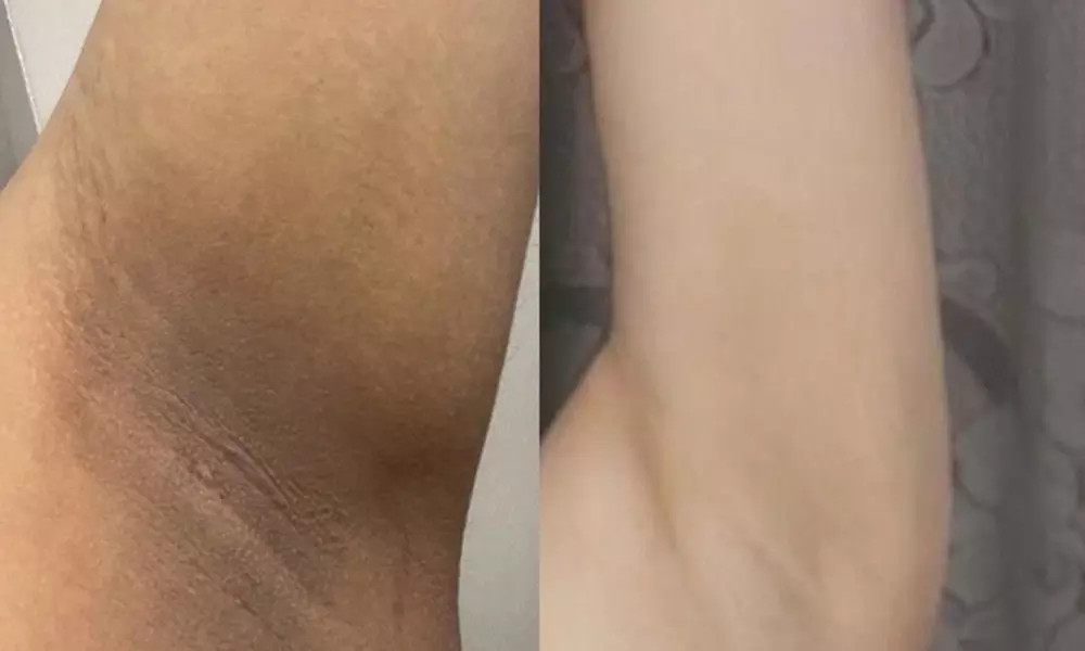 Targeted Skin Whitening Sessions for Underarms and Intimate Area