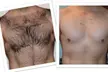 Up to 79% Off Six Laser Hair Removal Sessions for Small to XL Areas at Suite Six Medical Aesthetics - Second Medium