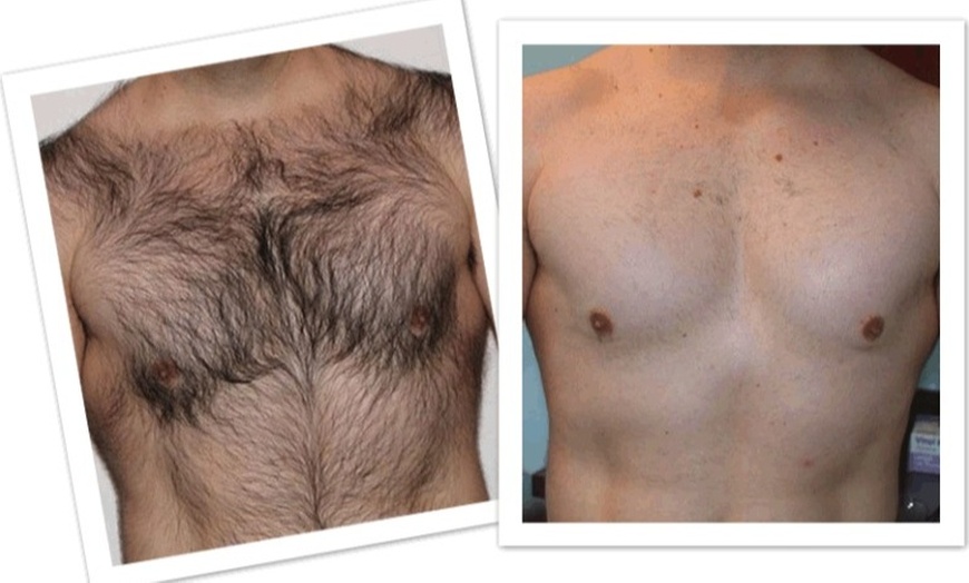 Image 5: Six Laser Hair Removal Sessions at Suite Six Medical, Small to XL Area