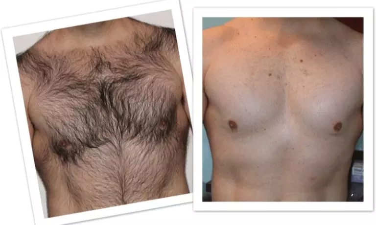 Six Laser Hair Removal Sessions at Suite Six Medical, Small to XL Area