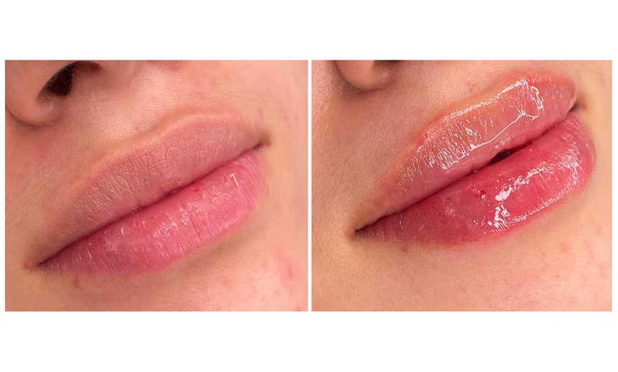 Image 18: 1 o 2 sesiones de rehidratación de labios o microlifting facial para 1