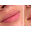 Image 18: 1 o 2 sesiones de rehidratación de labios o microlifting facial para 1