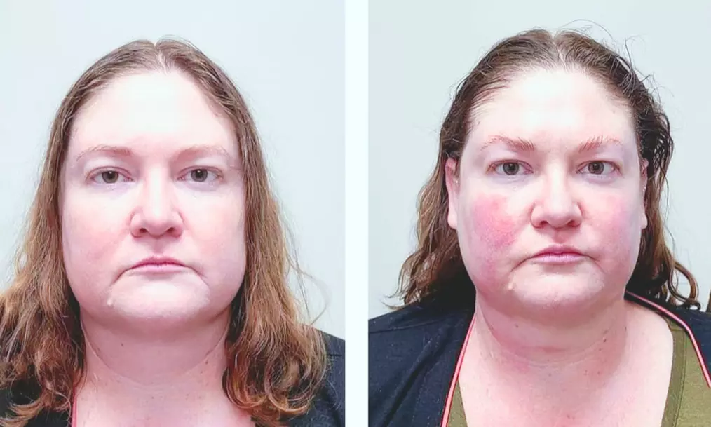 Lift and Tighten with Ultherapy Eye or Chin Treatment