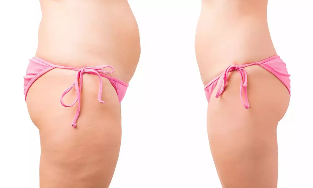 1x / 2x 60 Min. Kryolipolyse-Behandlung mit 8 Kälteplatten inkl. EMS