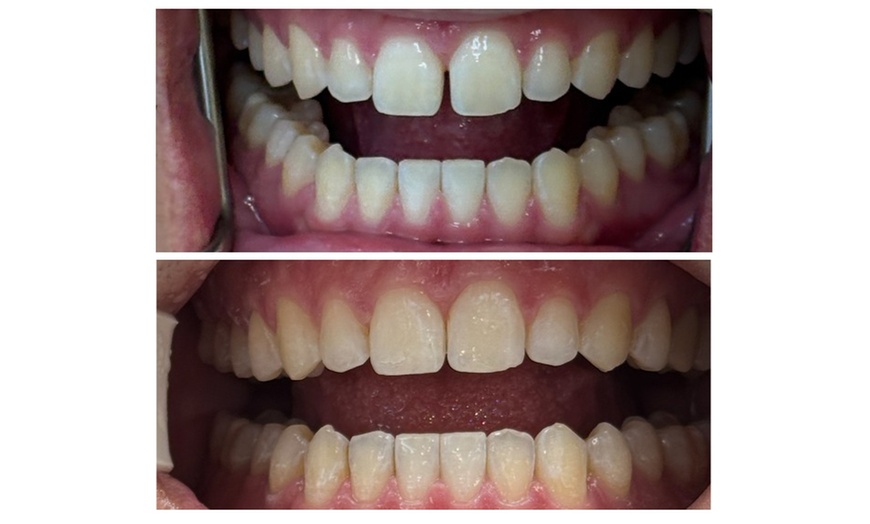 Image 4: Clear Aligner Teeth Straightening with Full Invisalign Package