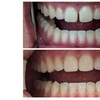 Image 4: Clear Aligner Teeth Straightening with Full Invisalign Package