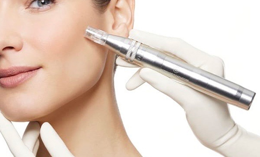 Image 4: Higiene facial profunda, opción a microdermoabrasión y radiofrecuencia