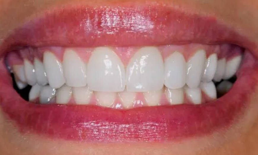 Image 2: Sesión de blanqueamiento led en Clínica dental Odontoss Antequera