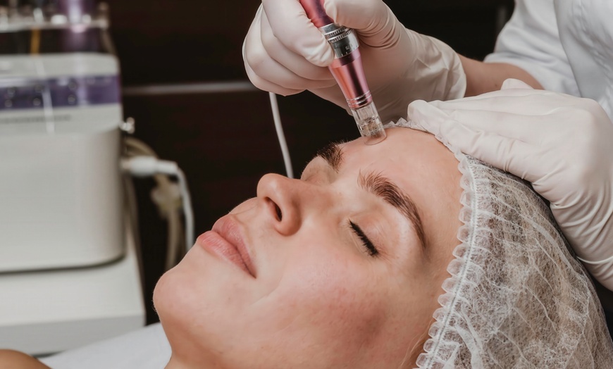 Image 2: Transform Your Skin with One or Three Sessions of PRP Facial