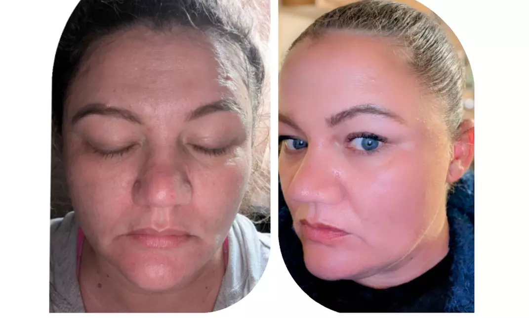 Refresh Your Glow with One or Two Chemical Peel w/w/o Dermaplaning