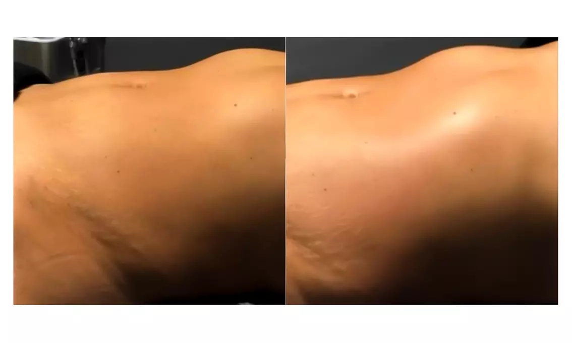 3, 6, 9, or 12 Cavitation, Radiofrequency, and Vacuum Package