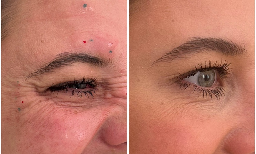 Image 11: Revitalize with 30 or 60 Units of Dysport at Youthful Glow