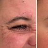 Image 11: Revitalize with 30 or 60 Units of Dysport at Youthful Glow