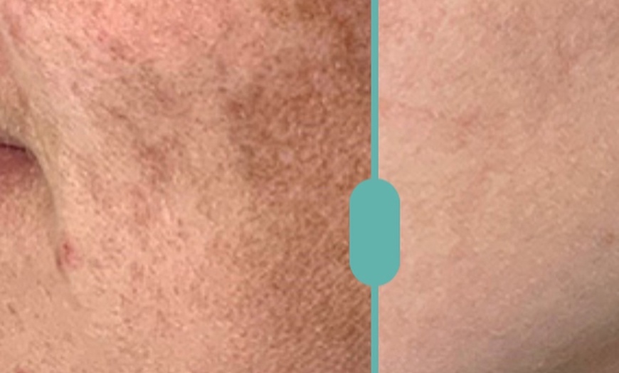 Image 2: Get Smooth Skin with IPL Lumecca Photo Facial Options