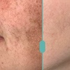 Image 2: Get Smooth Skin with IPL Lumecca Photo Facial Options