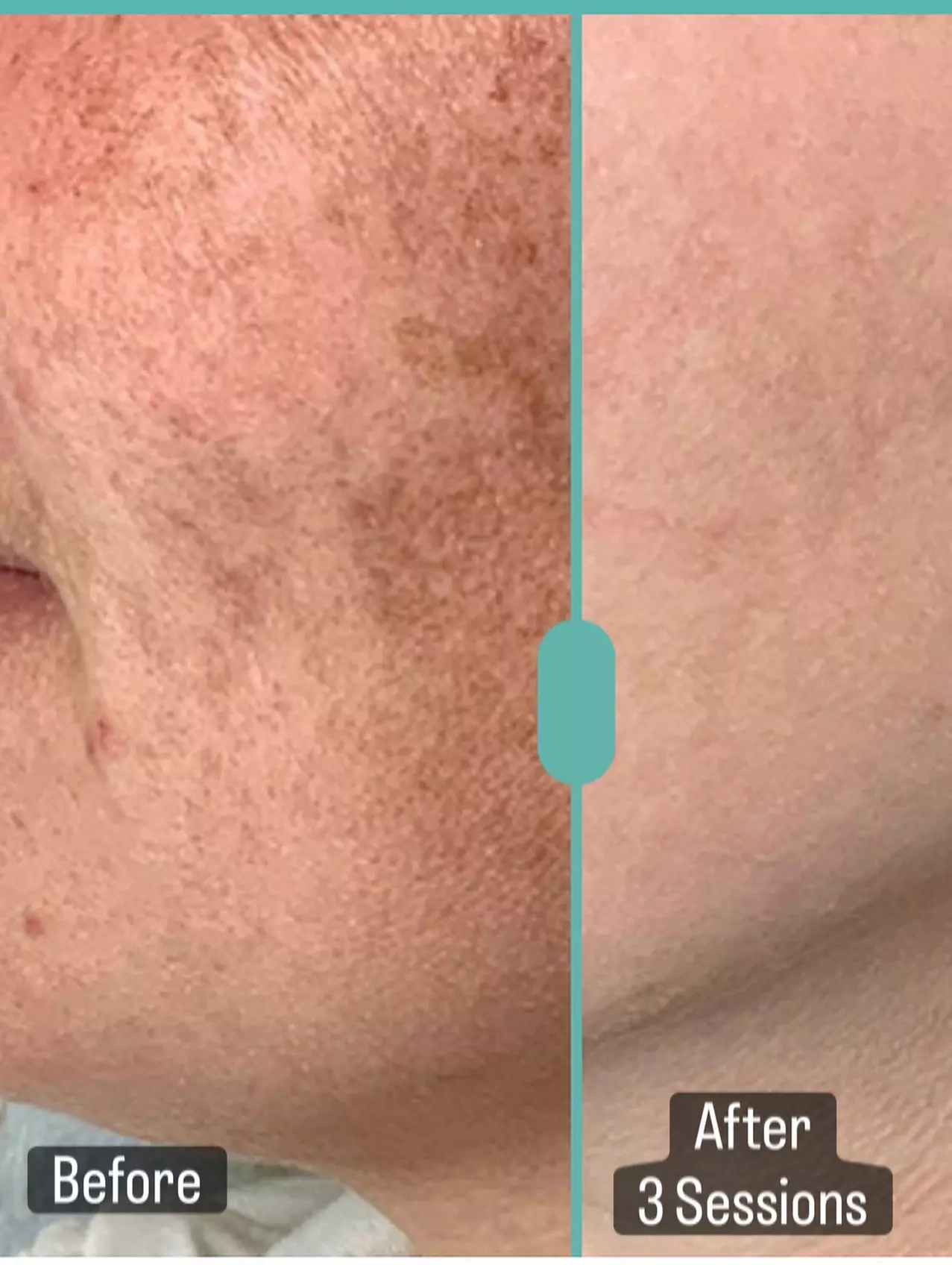 Get Smooth Skin with IPL Lumecca Photo Facial Options