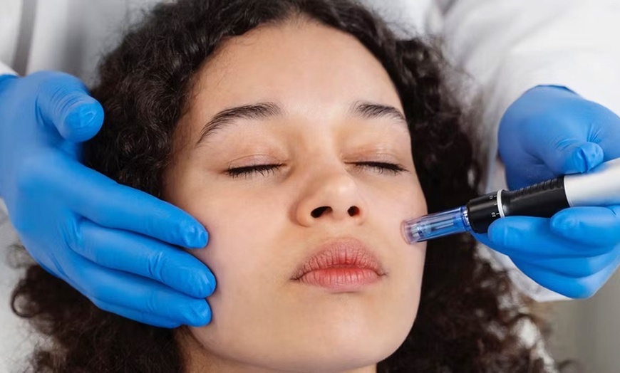 Image 1: Radiant Skin Starts Here – Full Face Skin Needling at Aqua Laser Clinic Hurstville