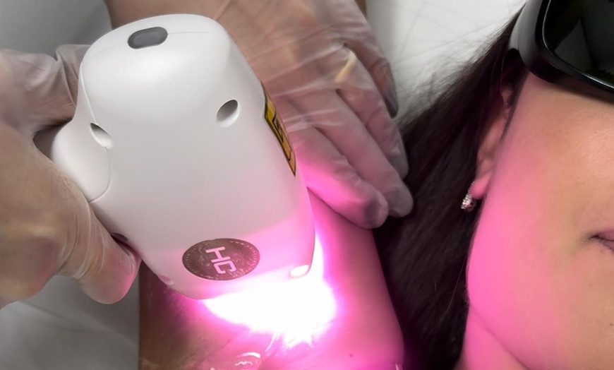 Image 1: 3x oder 5x Laser Haarentfernung an kleiner Zone für Frauen oder Männer