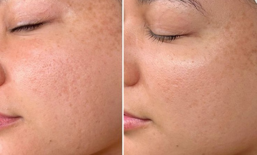 Image 4: One or Three Sessions: Polynucleotide Under Eye or Full-Face Treatment